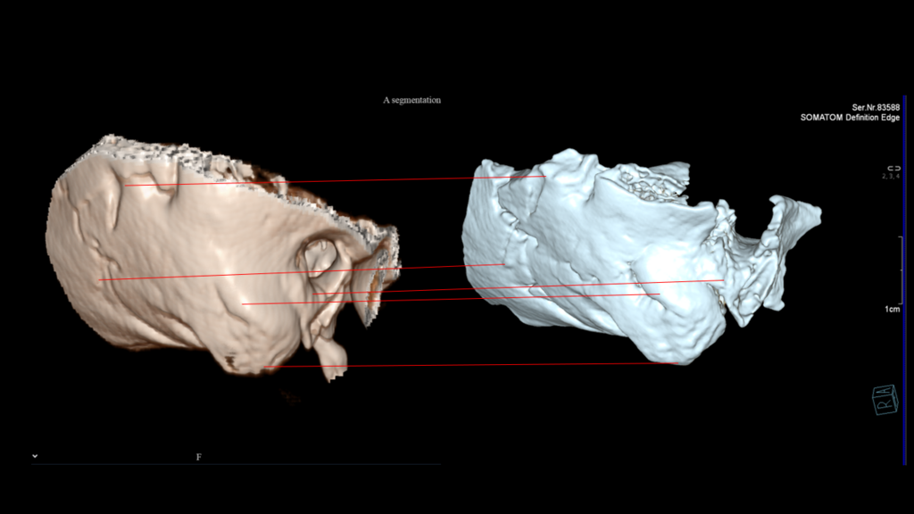 Comparing bone fragments to existing CT images on record in order to identify victims of the Hamas massacre במרכז הלאומי לרפואה משפטית זיהו את אחת הקורבנות באמצעות עצם זעירה