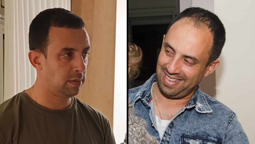 איתי משטבאון, לפני ואחרי השתלת שיער