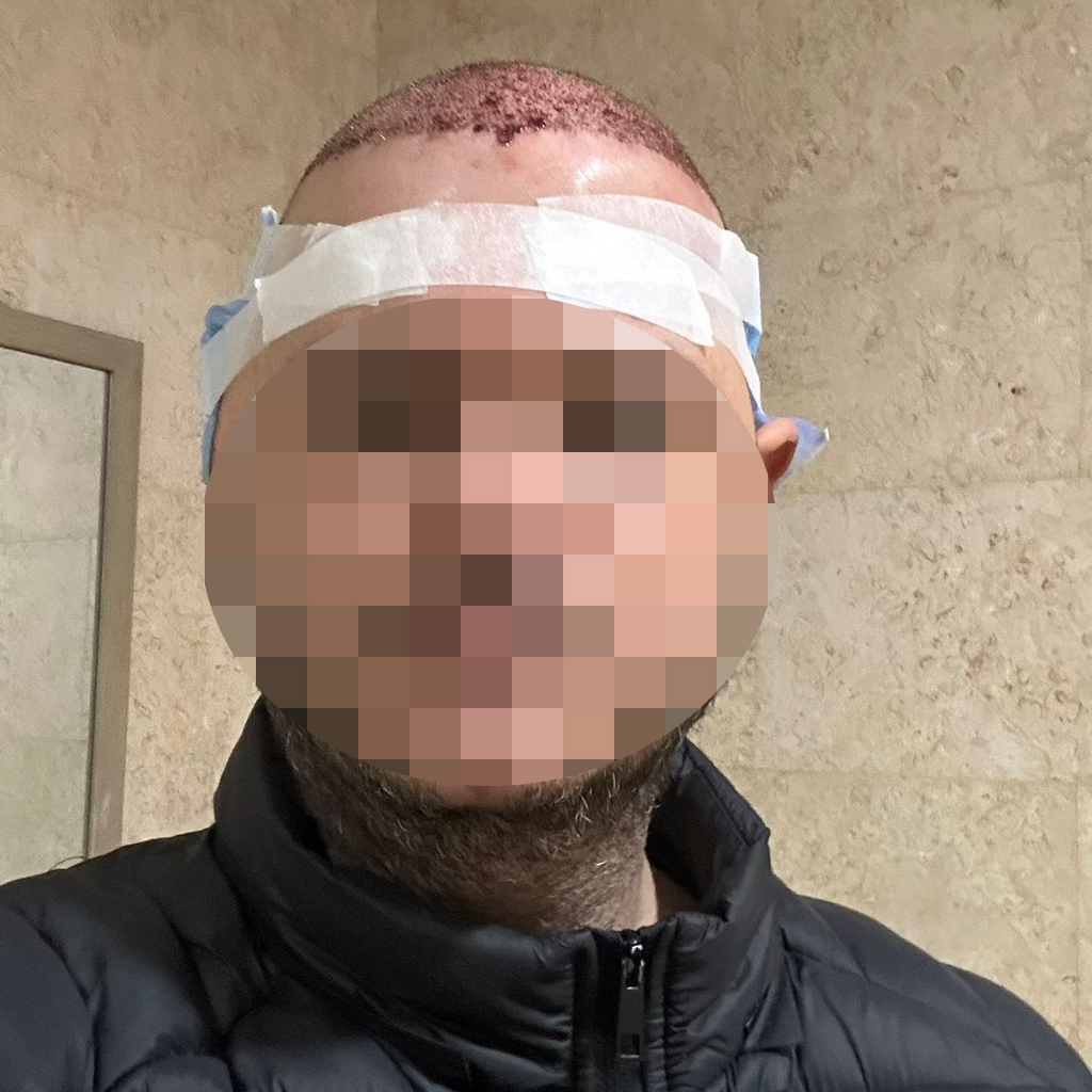 רותם, עבר השתלת שיער בישראל