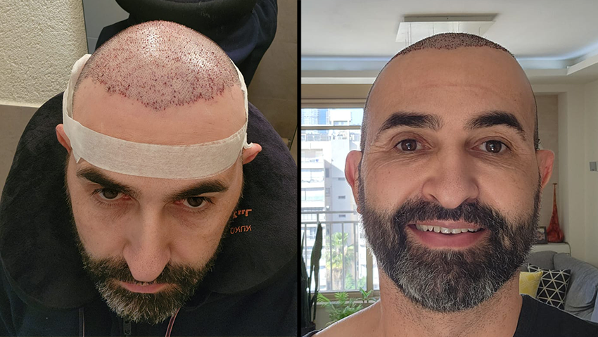 שמעון אזורה לאחר השתלת שיער בישראל