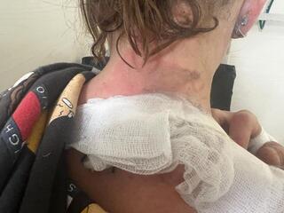 cigarette burn on neck Israeli woman's hair catches fire during cigarette break after lice  treatment