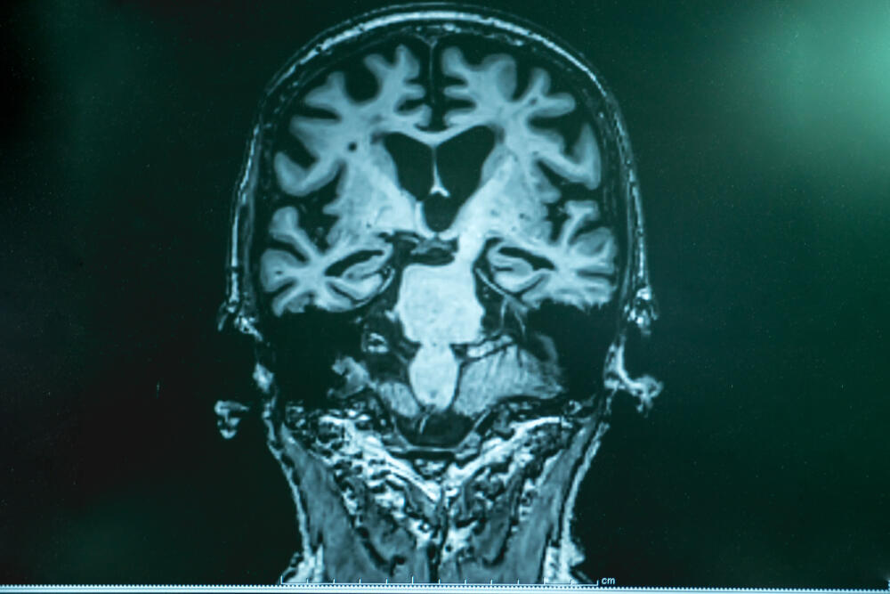 With an accuracy of 90%, a new combined blood test will allow early Alzheimer's diagnosis (Photo: Shutterstock) אלצהיימר דמנציה