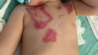 Burns in children: This is what you must do in the first moments