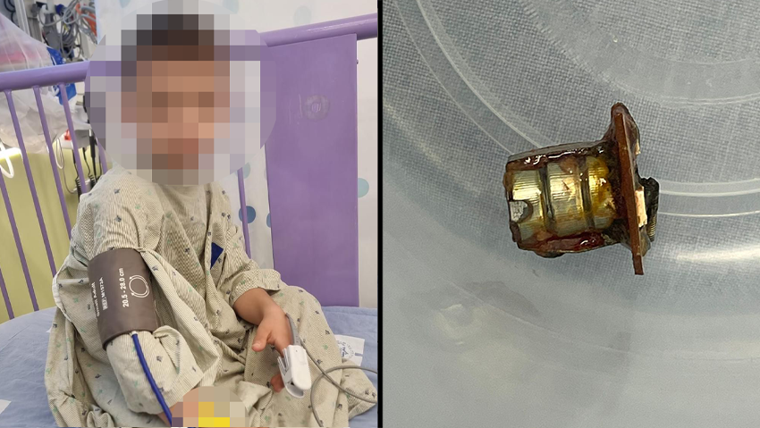 The batteries extracted from the child's esophagus (Photo: Hadassah Mt. Scopus) חייו של הילד ע' ניצלו בבית החולים הדסה הר הצופים לאחר שבלע סוללות