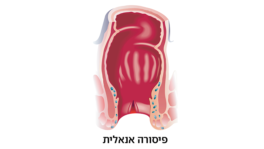 פיסורה אנאלית (צילום: shutterstock) פיסורה אנאלית