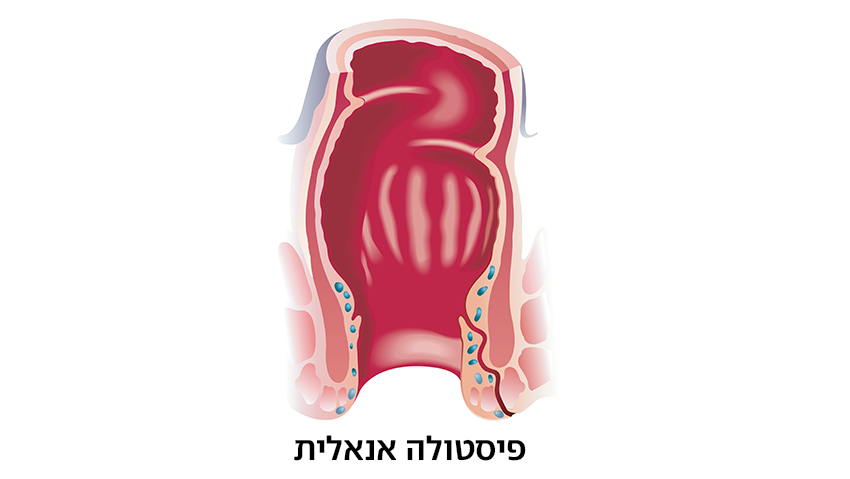פיסטולה אנאלית (צילום: shutterstock) פיסטולה אנאלית