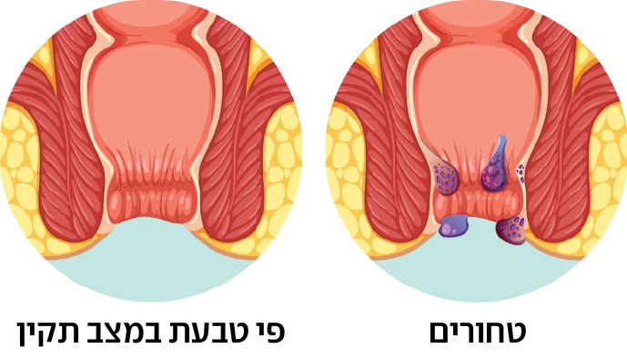צילום: shutterstock טחורים