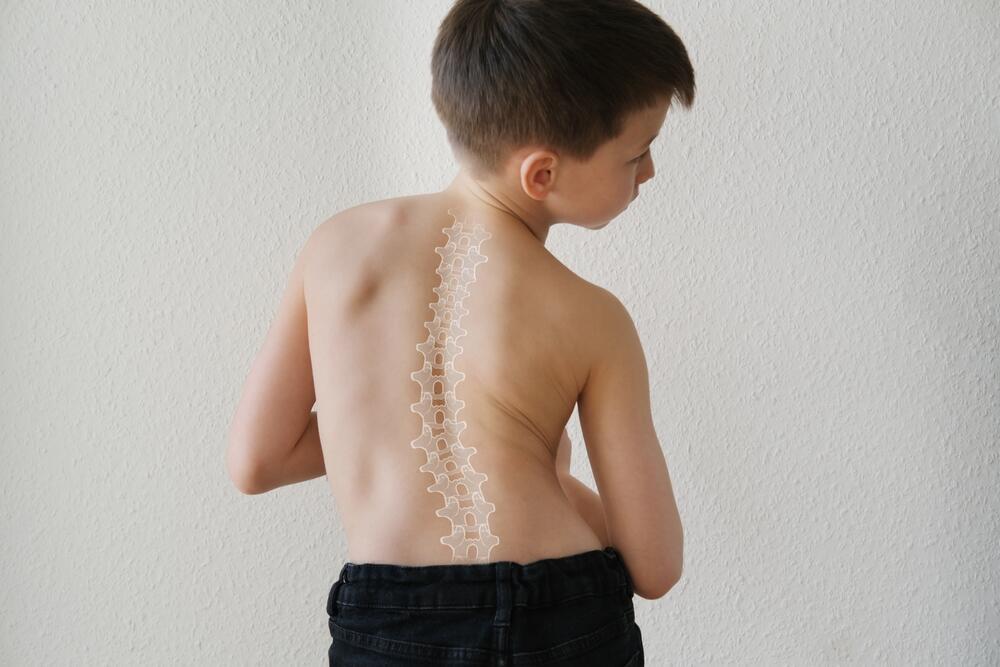 הסיבה להתפתחות עקמת לא ידועה (צילום: shutterstock) עקמת גב עקום כאבי גב ילד