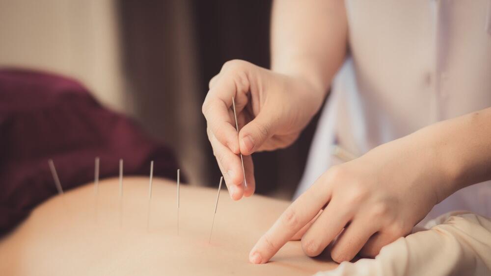 רפואה סינית דיקור סיני