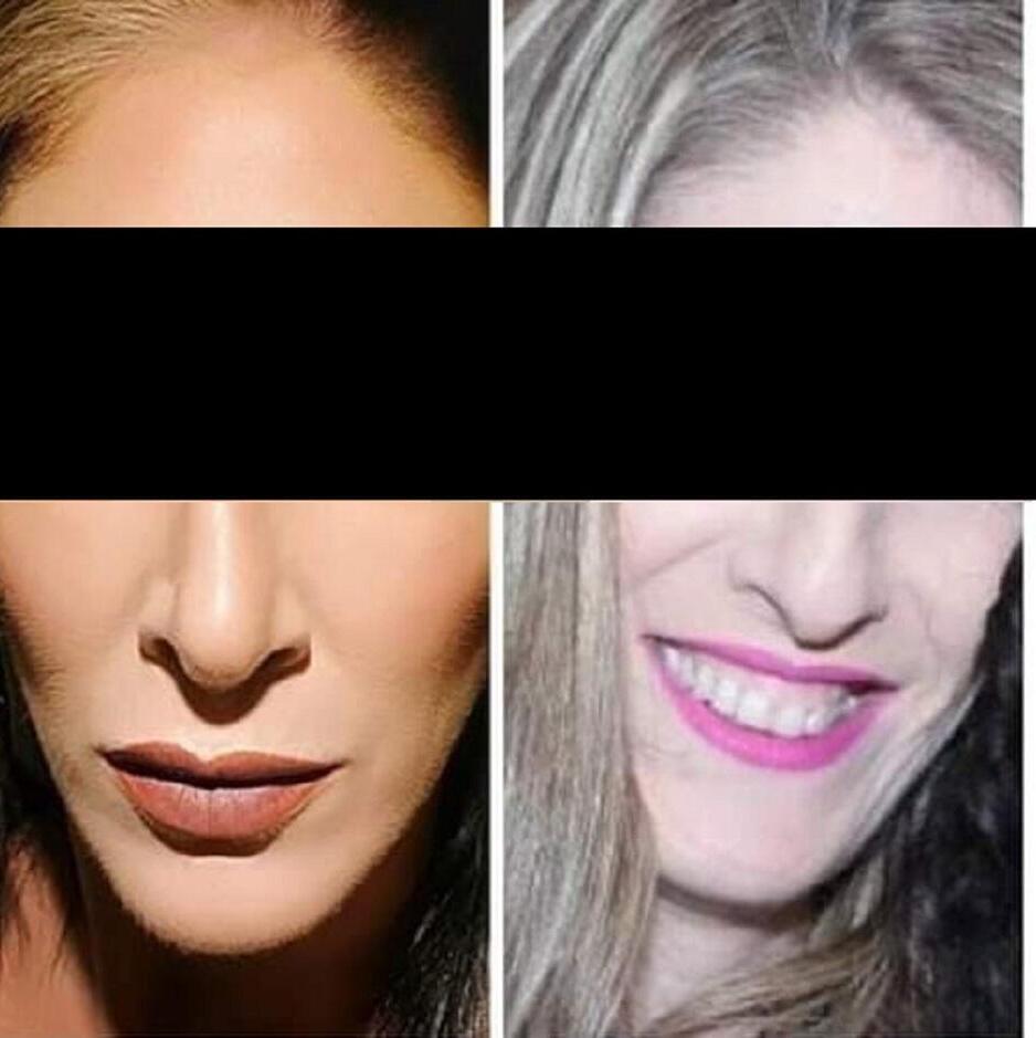 ''הרופא לקח אחריות''. נעמה לפני ואחרי הניתוח הראשון