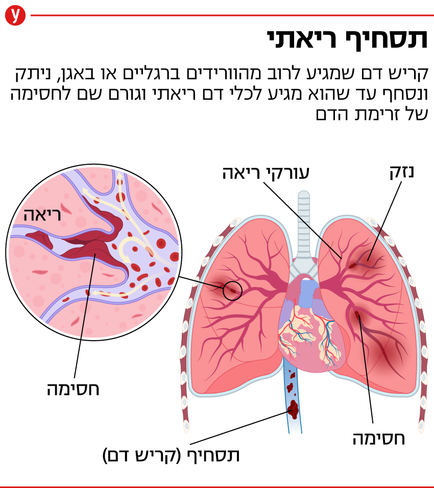 תסחיף ריאתי (איור: shutterstock) תסחיף ריאתי