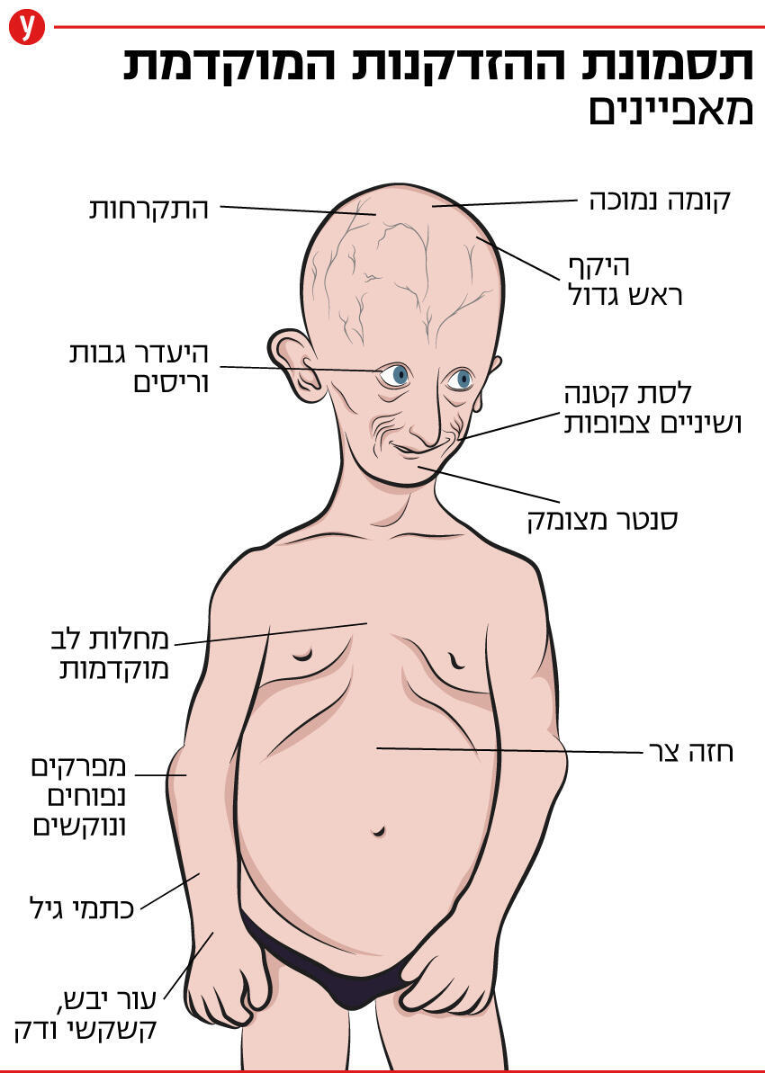 תסמונת הזדקנות מוקדמת (איור: shutterstock) תסמונת הזדקנות מוקדמת