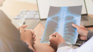 סרטן ריאות ריאה