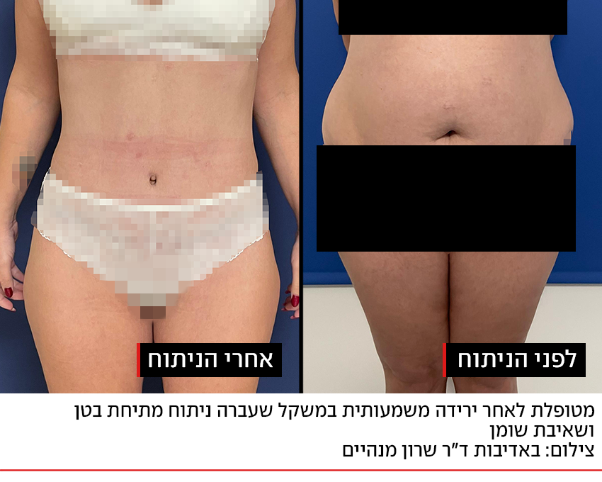 תוצאת ניתוח להסרת עודפי עור (צילום: באדיבות ד"ר שרון מנהיים) תוצאת ניתוח להסרת עודפי עור