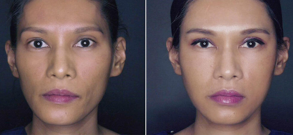 לפני ואחרי (מרפאת ד"ר רובינפור) רובינפור