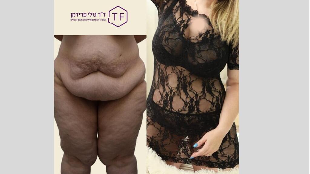 מטופלת של ד"ר טלי פרידמן