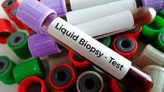 ביופסיה נוזלית לאבחון סרטן