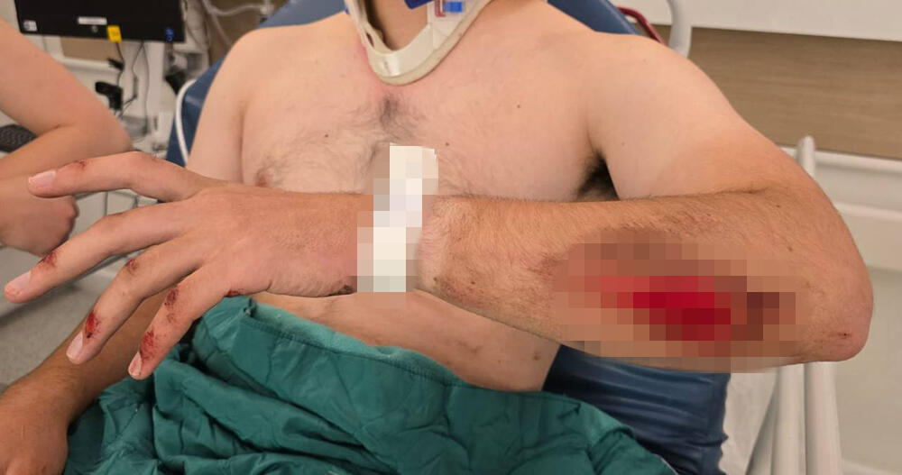 החבלות בידו של אחד הפצועים (צילום: איתן גליקמן) צעיר שנפצע בפיגוע הדריסה