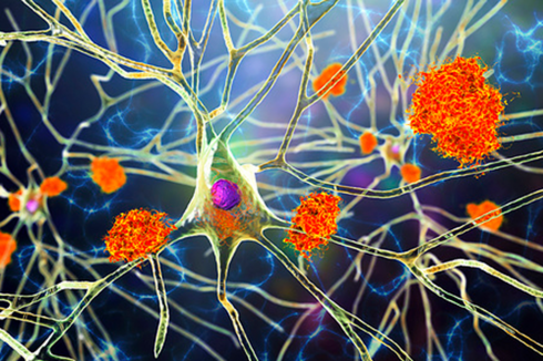 New clue in Alzheimer’s research