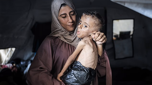 Complex medical conditions of Gaza toddler portrayed as starving in viral photo revealed