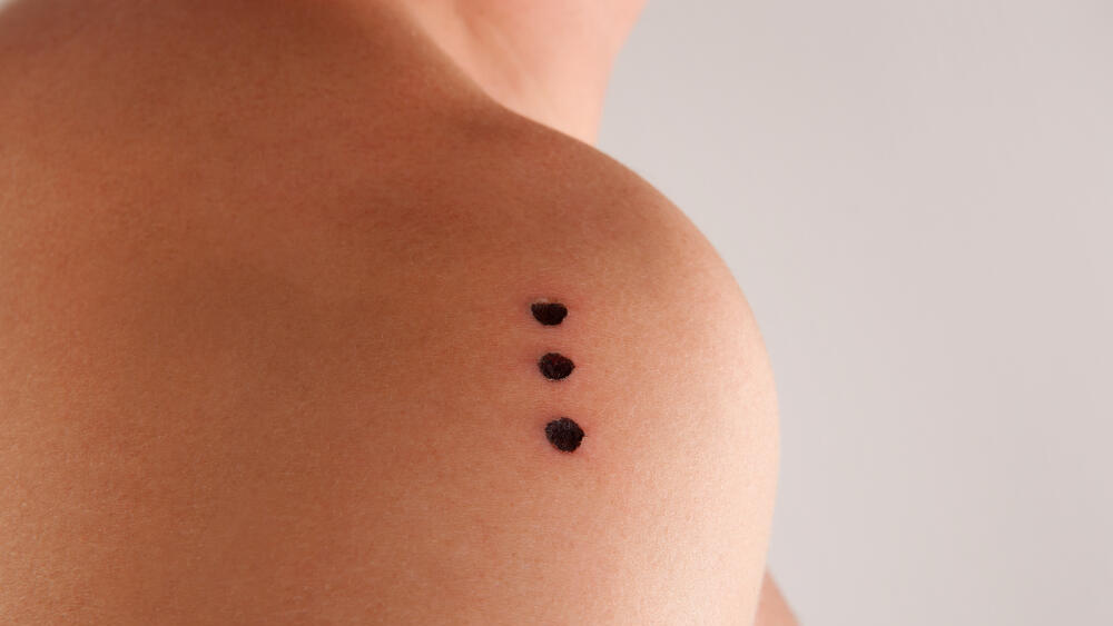 הצריבות שנשארות על העור לאחר הטקס