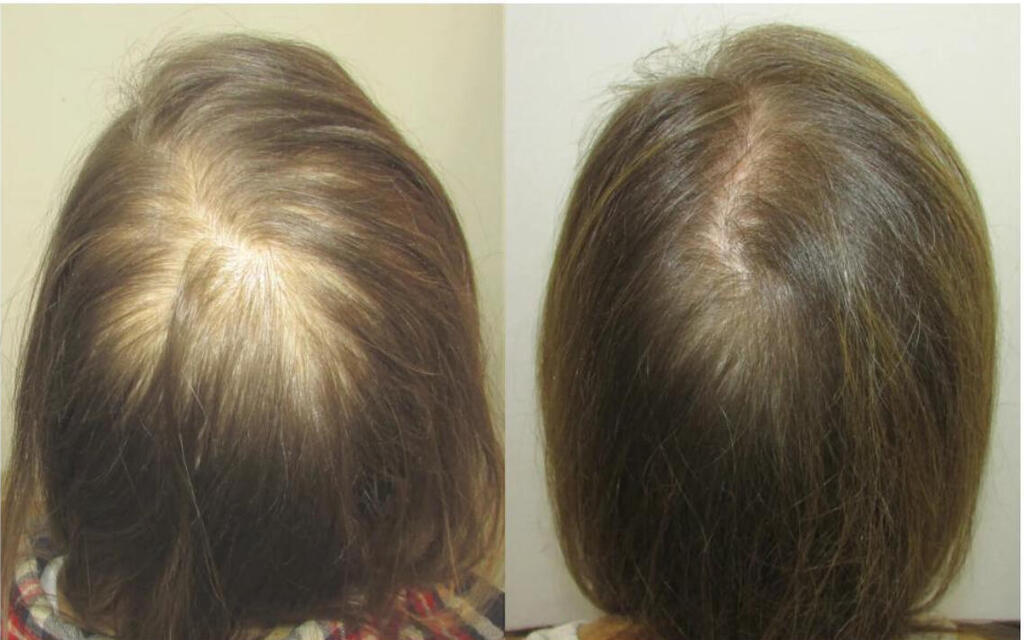 לפני ואחרי טיפול באקסוזומים