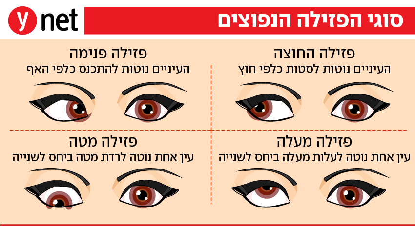 אינפו פזילה אינפו פזילה