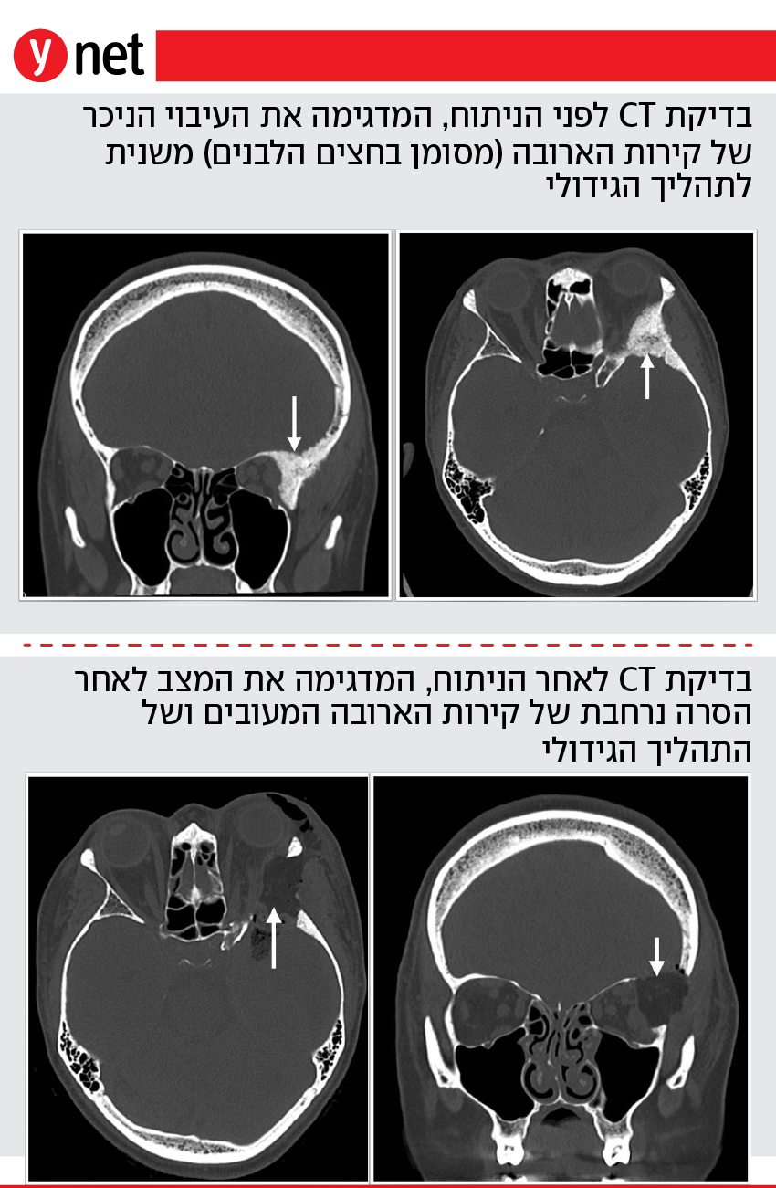 אינפו מתוקן ניתוח ארובת העין איכילוב