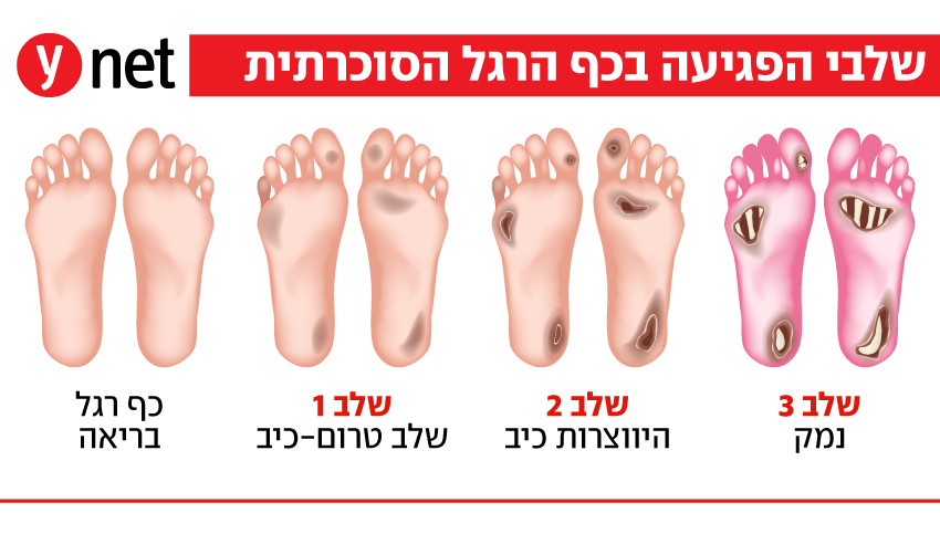 אינפו כף רגל סוכרתית אינפו כף רגל סוכרתית