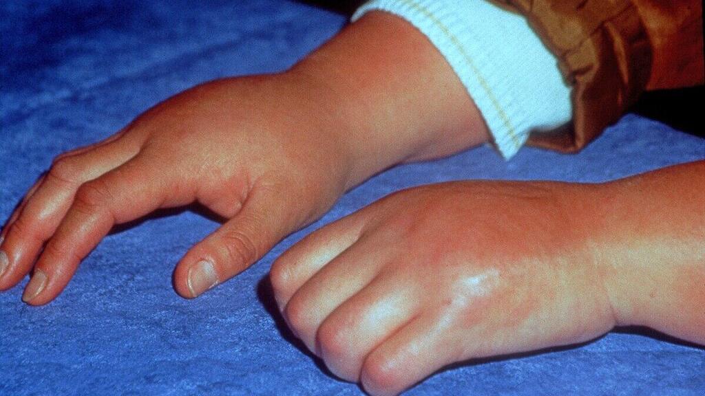 CRPS במצב ראשוני (צילום: מתוך ויקיפדיה) תסמונת כאב אזורי מורכב