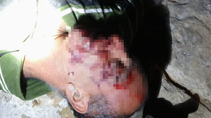 פלסטיני שהותקף על ידי מתנחלים במסאפר יטא הותקפו על ידי מתנחלים במסאפר יטא