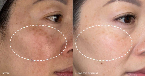 לפני ואחרי השימוש באקסובוסטר (תמונה: יח"צ דרמלוג'יקה) אקסוזום