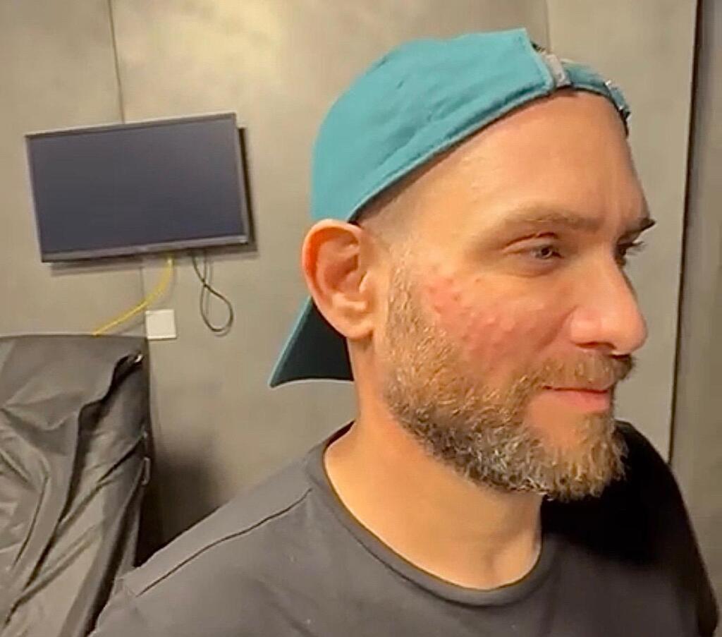 לאחר טיפול במרפאת SKIN