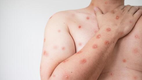 Israel sees first case of aggressive Mpox strain