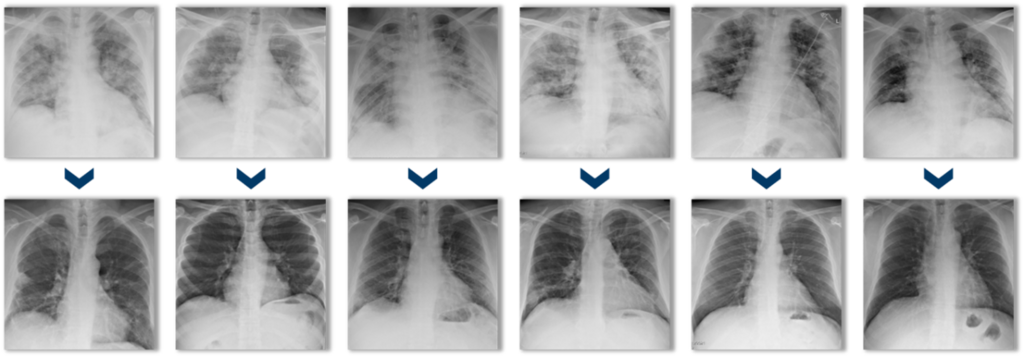 צילומי חזה של שישה מטופלים לפני טיפול במזנקיור (שורה עליונה) וכ-30 יום לאחר מכן (שורה תחתונה)