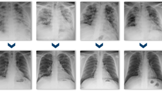 צילומי חזה של שישה מטופלים לפני טיפול במזנקיור (שורה עליונה) וכ-30 יום לאחר מכן (שורה תחתונה)