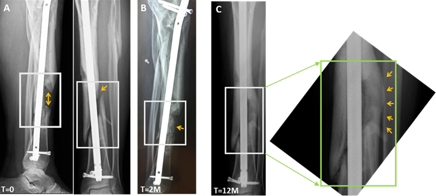 צילומי רנטגן של מטופל שהשתתף במחקר הקליני לטיפול בחסרי עצם בגפיים