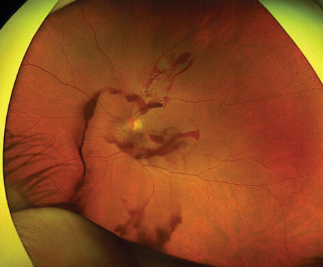 העין שנפגעה