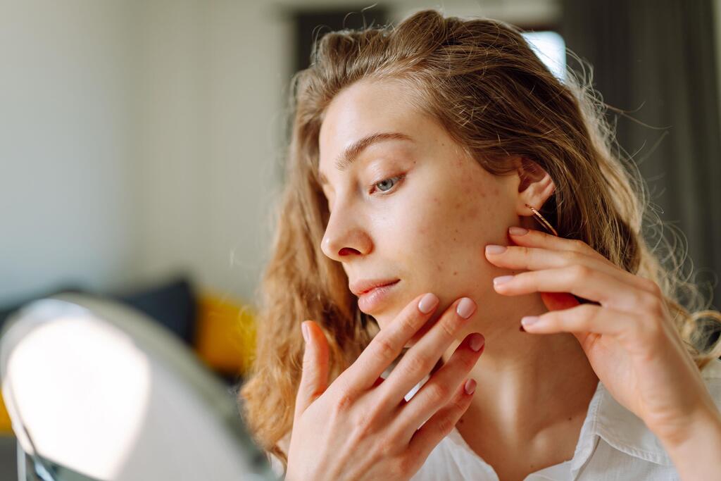 בעיות עור אקנה פיגמטציה נקבוביות פעורות