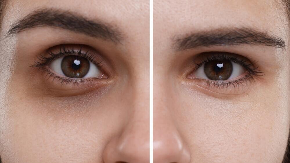 עיגולים שחורים מתחת לעיניים