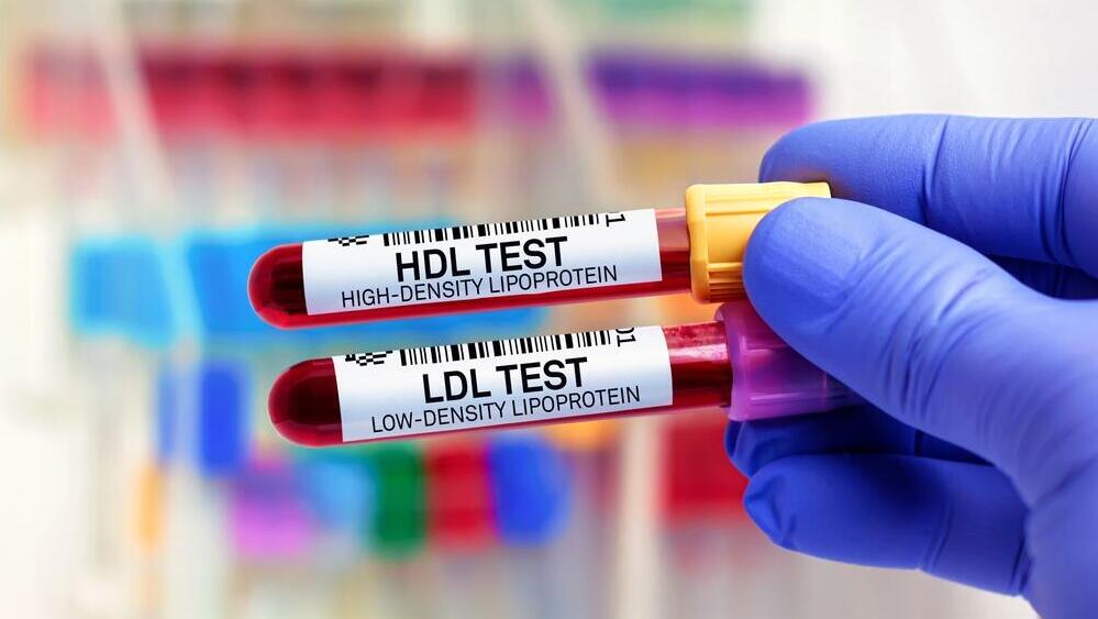 אצל אנשים מסוימים, העלייה בערכי ה-LDL עלולה להיות דרמטית (צילום: Shutterstock) כולסטרול, בדיקת דם LDL