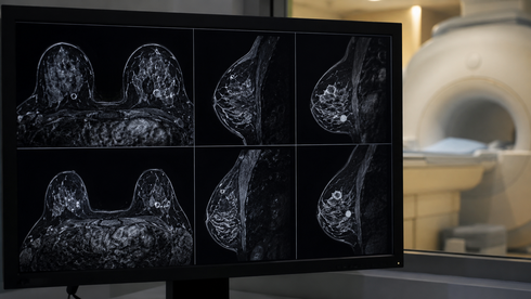 AI breakthrough could make breast cancer MRI scans faster, sharper and more accessibl