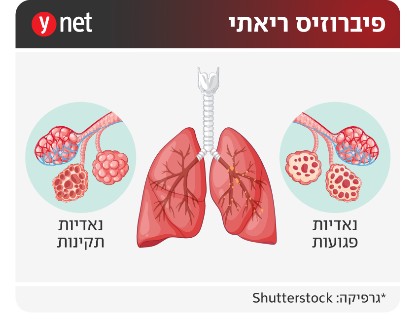 אינפו פיברוזיס ריאתי