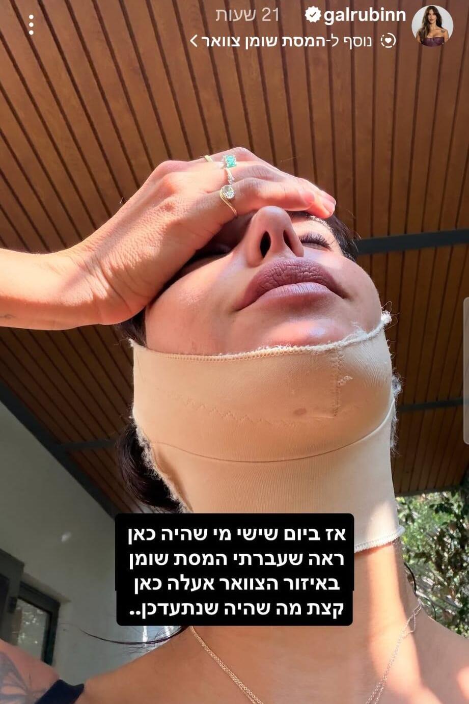 עד שהכול עובר לחלוטין יכולים לחלוף שבועיים (תמונה מתוך האינסטגרם של גל רובין) גל רובין שאיבת שומן