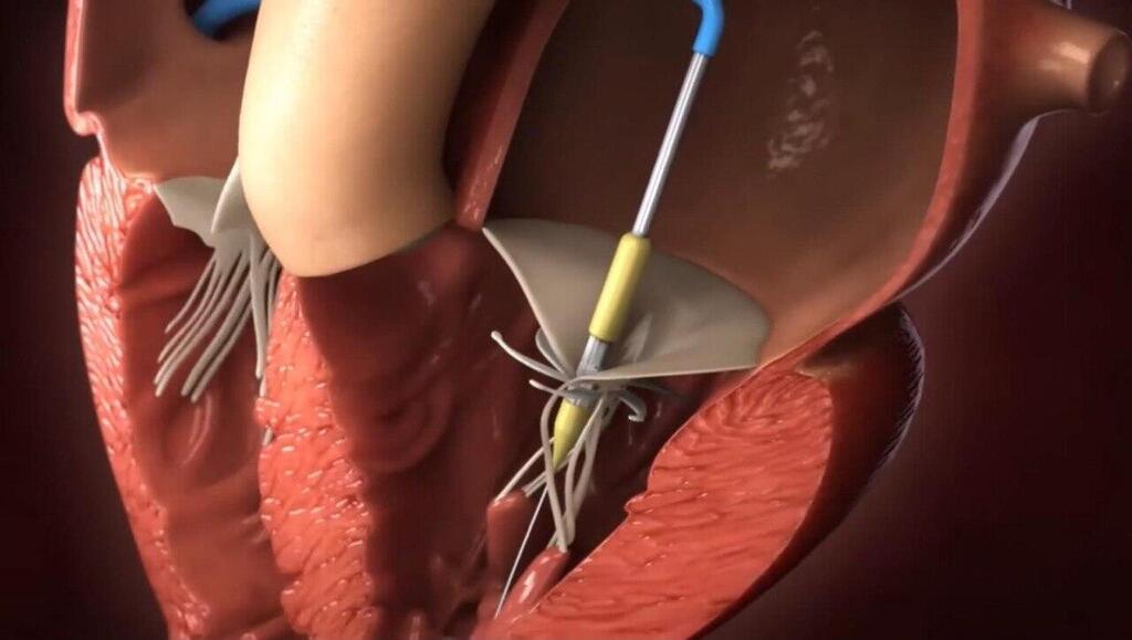 Simulation of the valve implantation (Photo: Innovalve) תמונת CT בה רואים את המסתם של אינוולב (החלק הלבן) שהושתל בבן-אדם